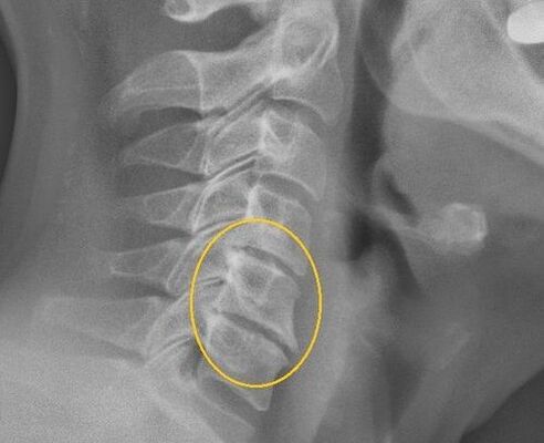 Bir X -Ray'de servikal omurganın osteokondrozu