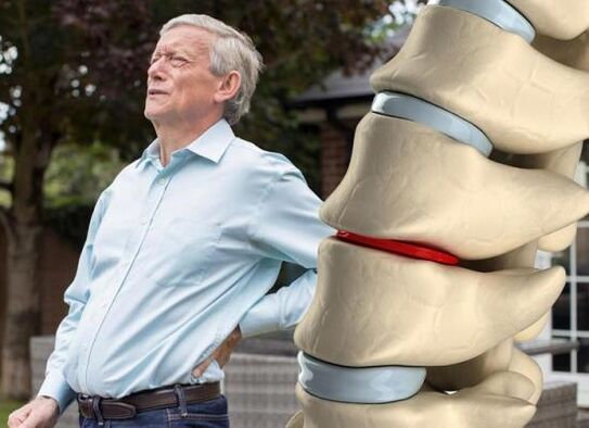 Osteokondroz intervertebral diskleri etkiler ve sırt ağrısına neden olur