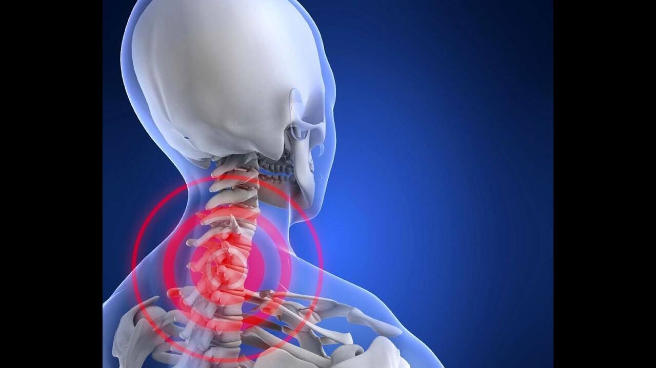 Servikal omurganın osteokondrozu